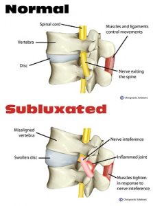 Nerve damage in spinal column